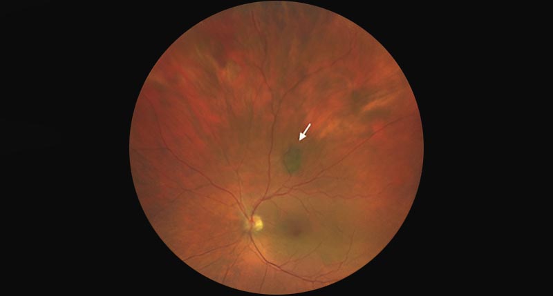 When a Freckle in the Eye Isn’t Just a Freckle